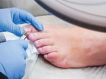 Evde Batmış Tırnak Çekimi